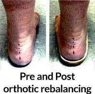 orthotics